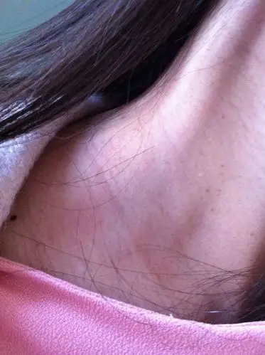 怀孕后刚开始没有,这段时间发现脖子上慢慢长出了黑点而且还是突出来