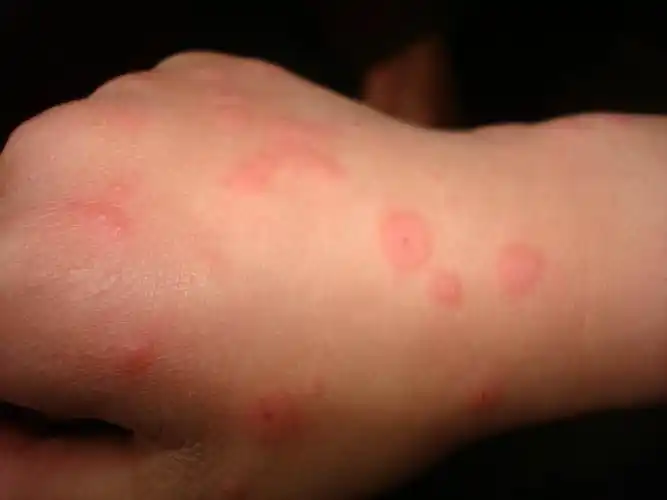 看图诊断21……多形红斑