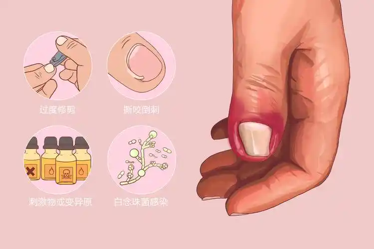 美甲虽好,也要预防"指甲病"_细菌_人体_甲下