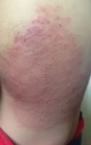 不知道我老公屁股上面长的什么:他说很痒!不痛