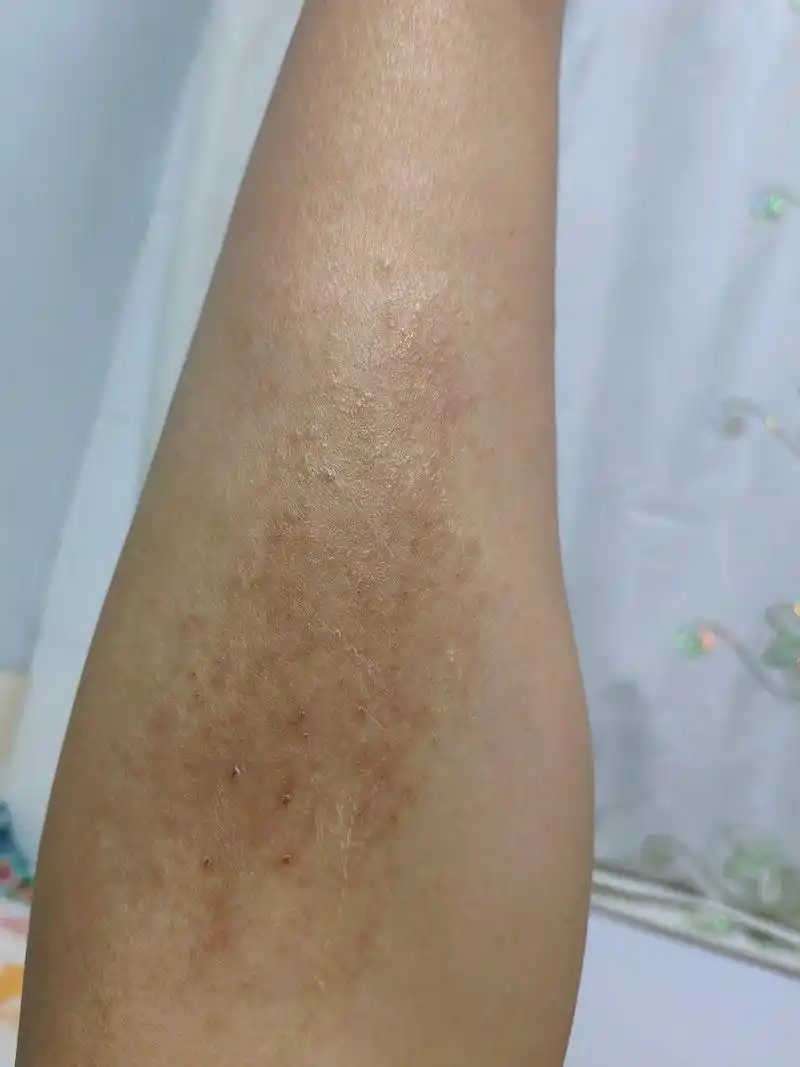 小腿起了一片疙瘩 一个月以前就觉得腿有点痒我就挠挠挠的 越挠越红