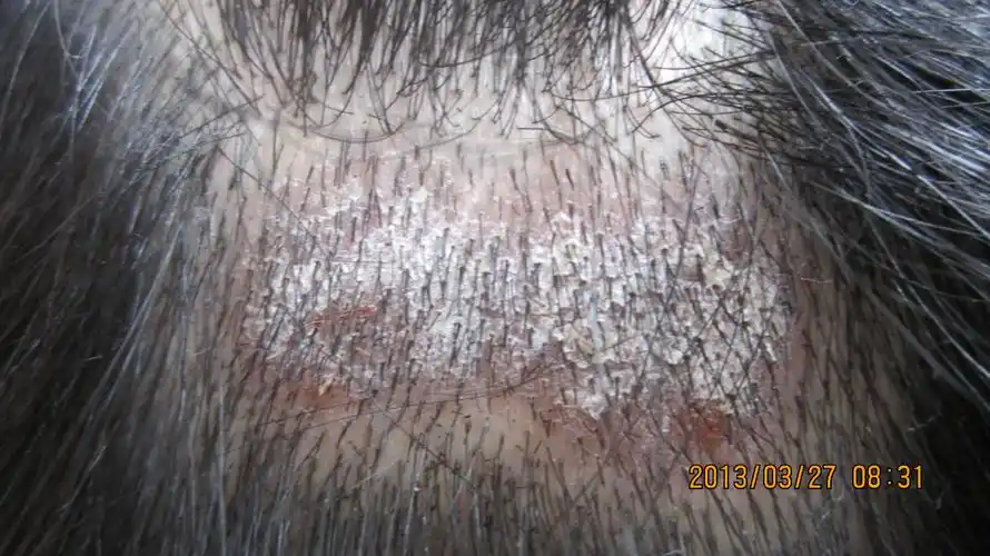 6楼回复想__拟2013-03-27 09:38:10刚才让患者把皮损处的头发剃掉了