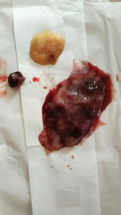 怀孕60多天无胎心自然流产了,流出的东西是否流完了,图片最小的黑红色