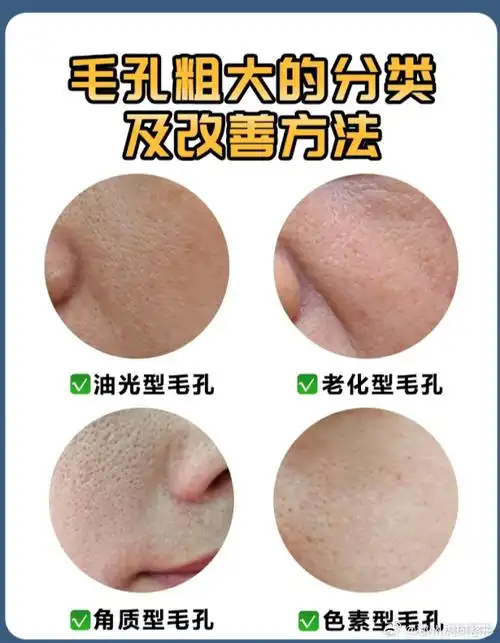 毛孔粗大 是很多朋友都头疼的烦恼,按照成因和表现一般分为4大类型