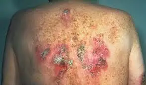 艾滋病晚期症状图片:皮肤溃烂