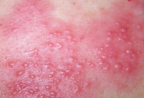 皮肤热毒图片 (30)_有来医生