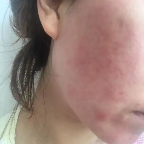 请大家给帮忙看看,这是湿疹还是过敏了?