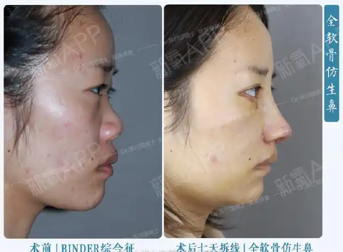 [:13]"binder综合症"又称先天性中面部凹_圈子-新氧美容整形