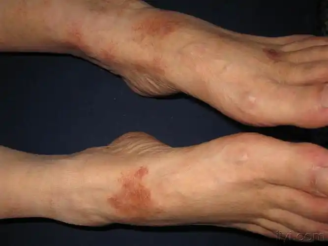 看图识病··········下肢色素斑