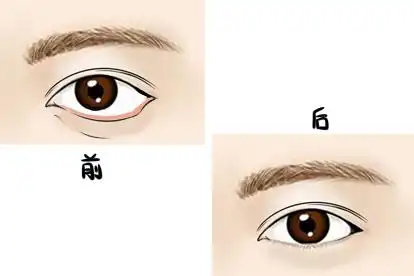 下眼睑外翻修复前后图片