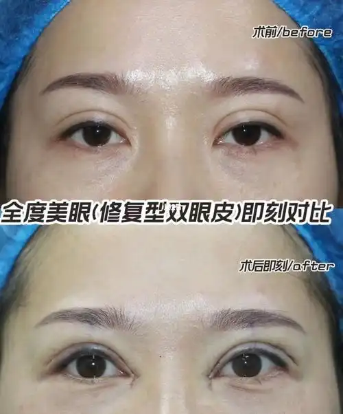 【双眼皮修复】刚做完的对比～_双眼皮_全切双眼皮_双眼皮手术_双眼皮