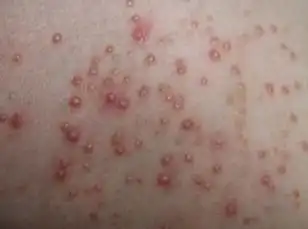 2毛囊炎的诊断>>>轻松预约,治好毛囊炎>>>消除毛囊炎抗复发,点击预约