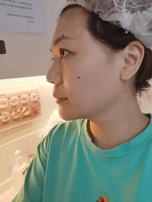 乔雅登玻尿酸填充鼻子~#玻尿酸鼻子