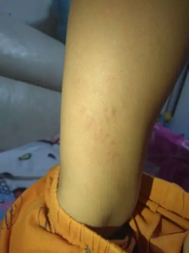 孩子大腿内测起小疙瘩,孩子老挠,看着痒痒