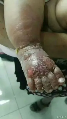 这些孩子们太惨了, 一双双小脚严重肿胀, 鼓起巨大的水泡, 皮肤溃烂到