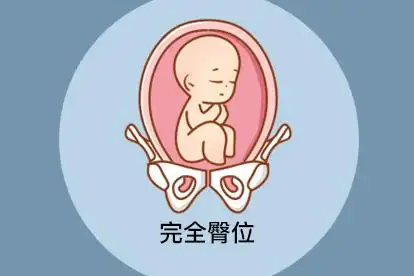 胎儿臀位是什么姿势图