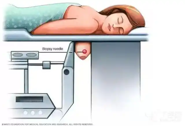 乳腺肿瘤穿刺活检会导致癌细胞转移一篇告诉你穿刺活检的全部知识点