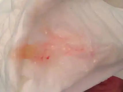 白带有血丝图片