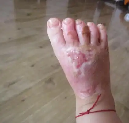 浅二度烫伤图片38