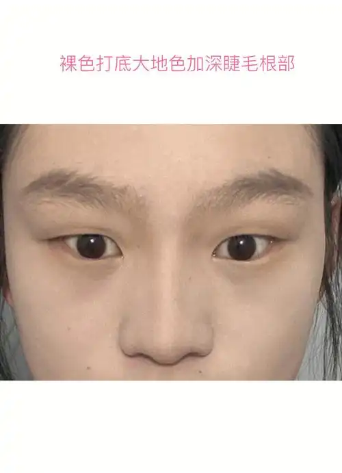 单眼皮变双眼皮流程