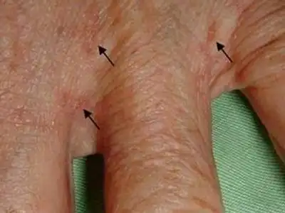 疥疮的症状和图片 - 有来医生