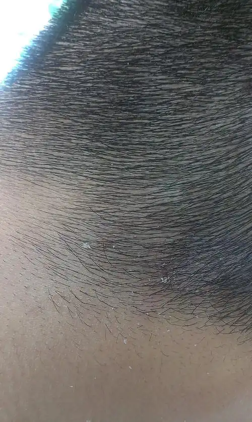 头皮后面有癣斑,有皮屑,有点痒是怎么回事?