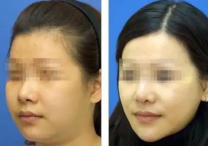 淮安市妇幼保健院肉毒素注射的成功案例