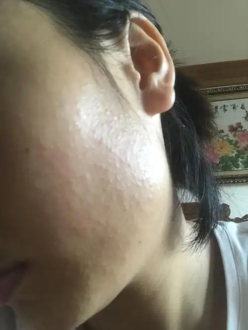 仙女们 在脸颊两侧的这是闭口吗?