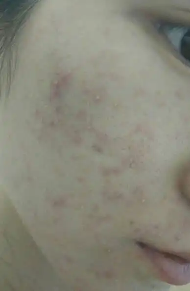 问:脸上突然长了很多细小的水泡,泛红,有些刺痛,皮肤粗糙,想知道是