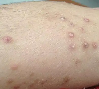 为什么万病之源始于湿气