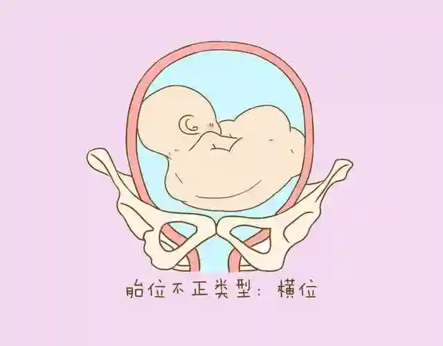 胎儿横位让人焦虑别怕学会这2招尽早纠正胎儿体位