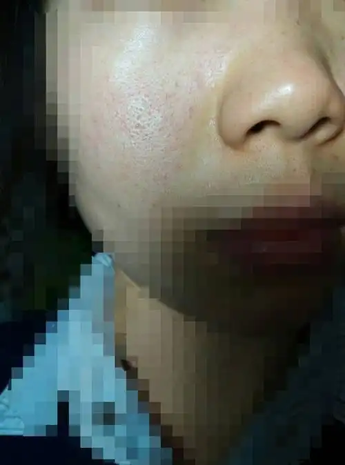 皮肤毛孔堵住了,毛孔粗大,挤一挤有黄色颗粒出来,不挤的话表面是黑色