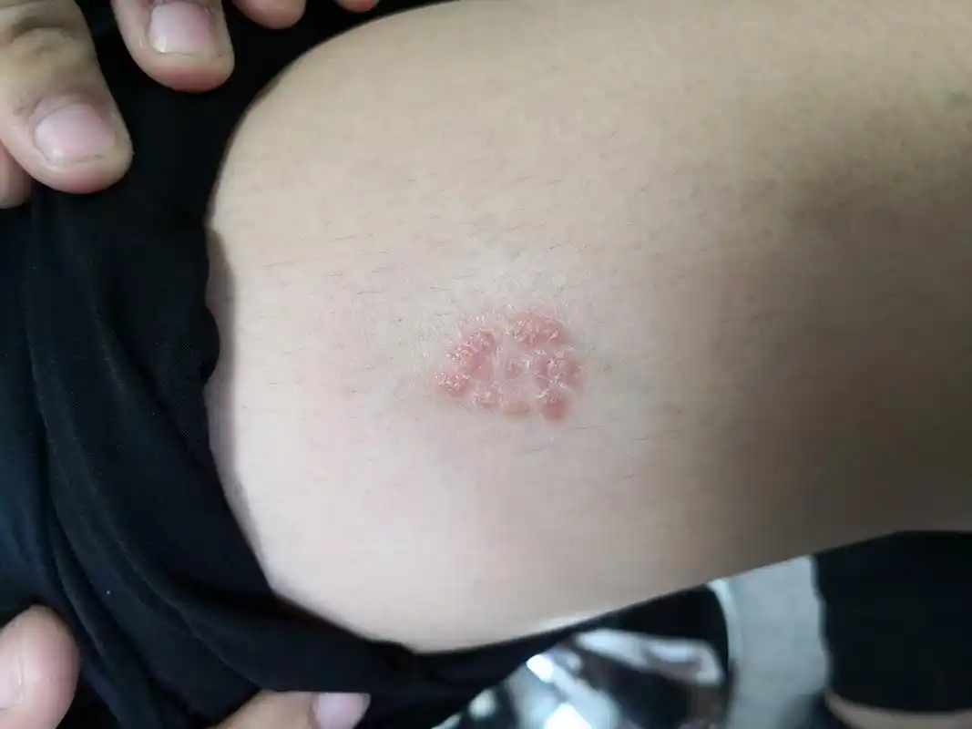 银屑病并发背部马拉色菌毛囊炎症状#解决皮肤问题专注皮肤美容##银屑