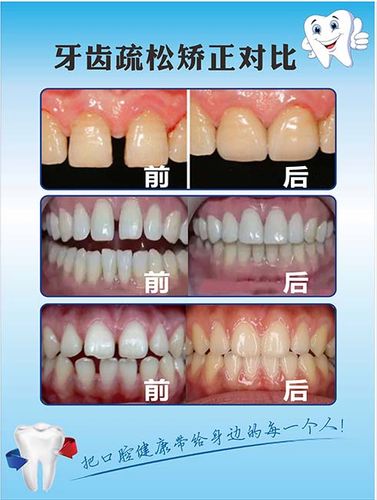 m769牙齿疏松矫正前后对比图口腔科墙贴画kt展板写真海报印制2371
