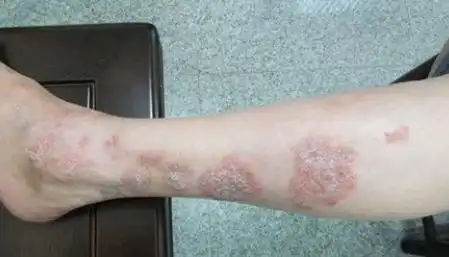 腿上出现白色的癣块,是一种常见的皮肤病症状,很多人都会遭遇.