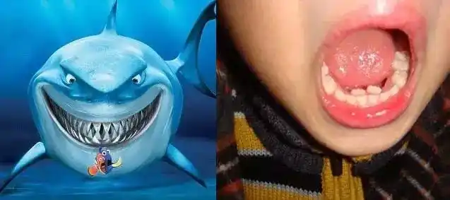 宝宝一口"鲨鱼牙"引网友热议,医生:这锅家长必须背_牙齿