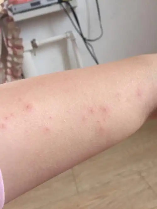 胳膊上起红点 不痒 现在脖子 脸上都有了 这是什么啊?感觉不像湿疹呢