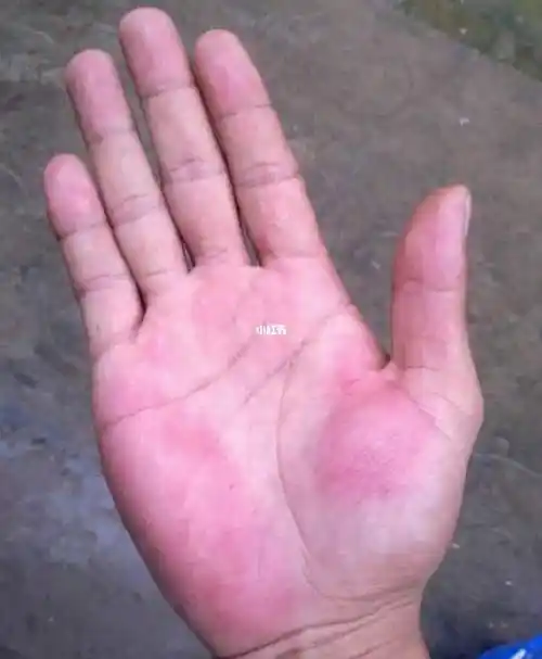 女手掌心大拇指发青(手掌大拇指发青是怎么回事)