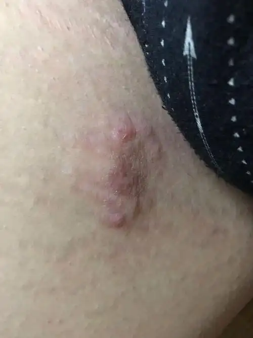 难言之隐——股癣