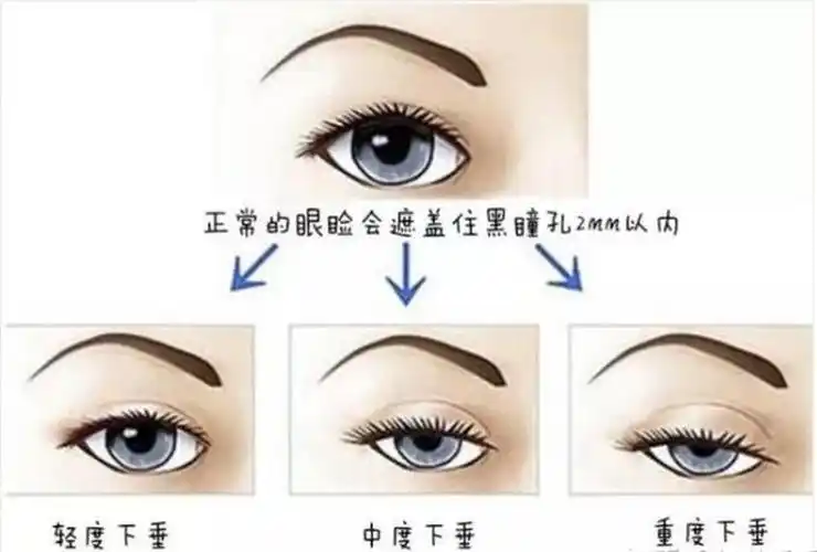 如何判断自己是否是上眼睑下垂?简单一个小动作就自行判断