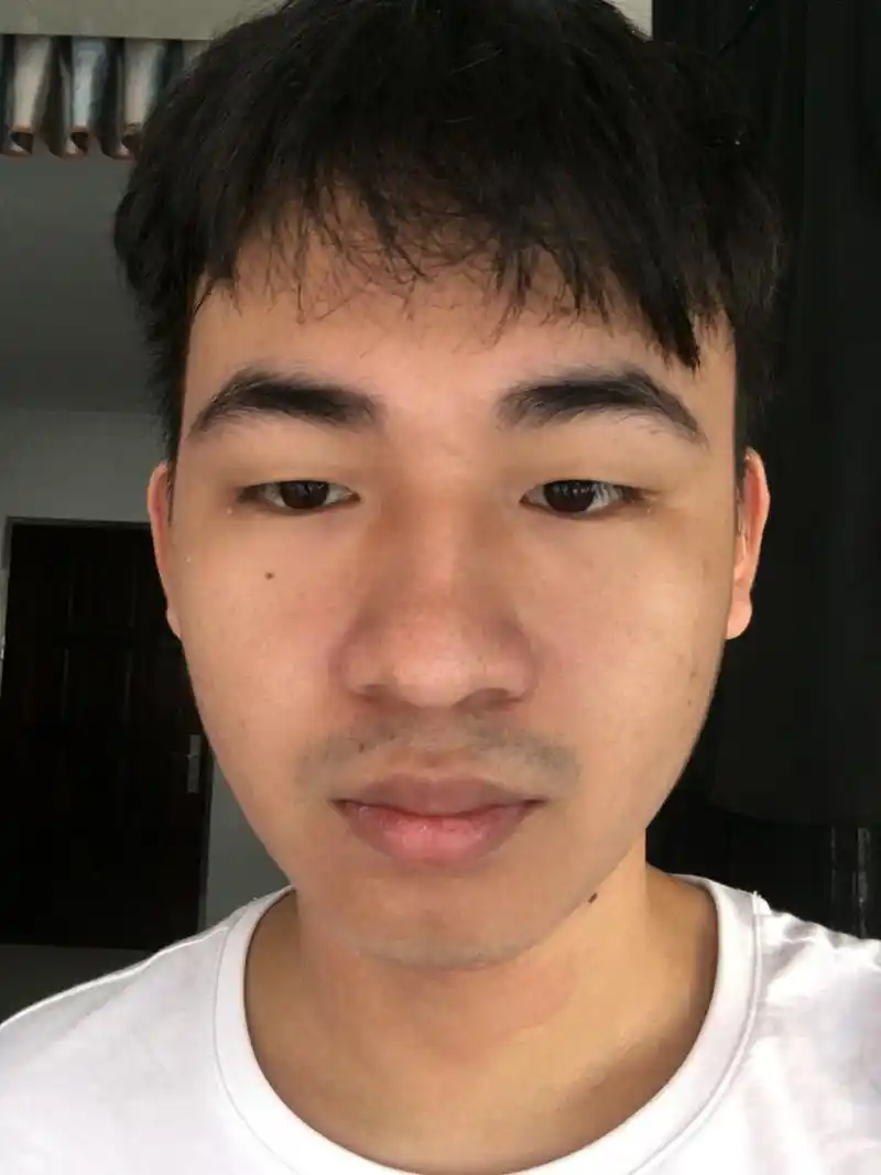 眼睛提肌无力.上睑下垂.