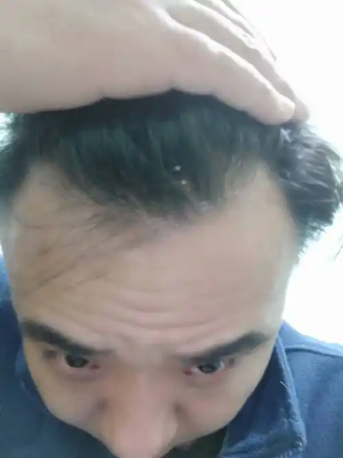 我本人爱抽烟,爱吃油腻食物,现在两额角头发有点希,还比较细轻微发黄