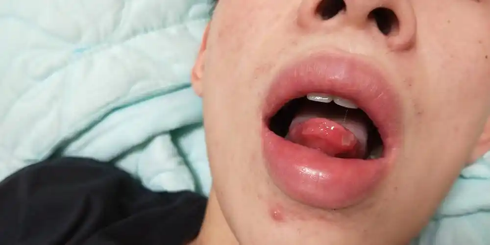 中药辅以红蓝光治疗顽固性口腔溃疡(白塞氏)个案日志