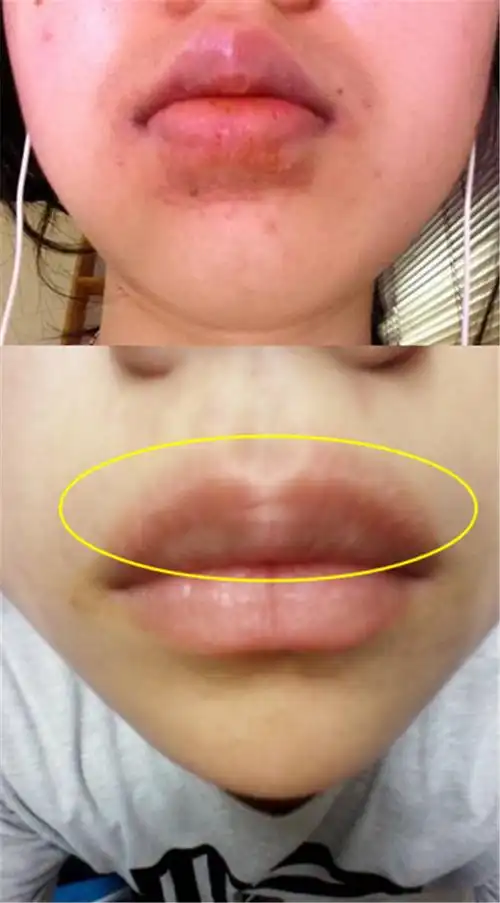 吃芒果过敏的症状图片吃芒果过敏了怎么办