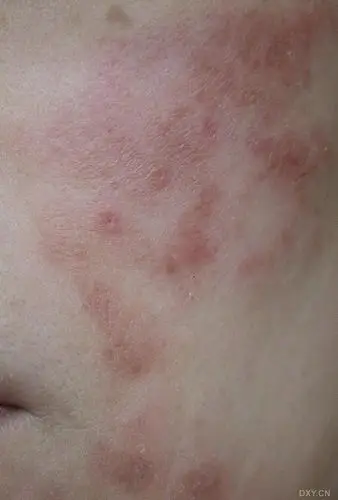 附图 - 皮肤与性传播疾病讨论版 -丁香园论坛