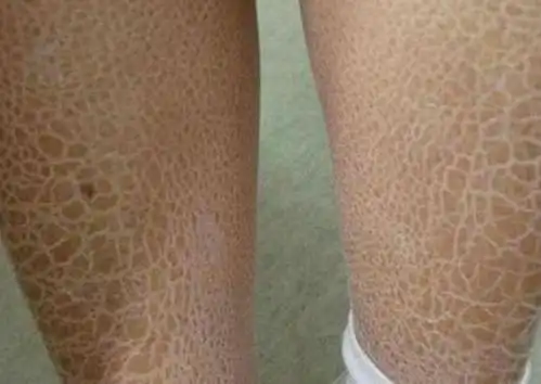 身体出现这5个现象9成是患上了糖尿病,5招可以缓解!