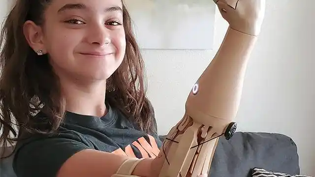 nx 帮助革新儿童个性化手臂假肢的远程开发 | siemens software