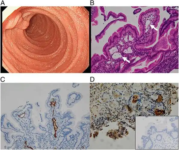 图a.肠镜显示小肠粘膜上分布有一些白色的绒毛及部分乳糜性渗出;图b.