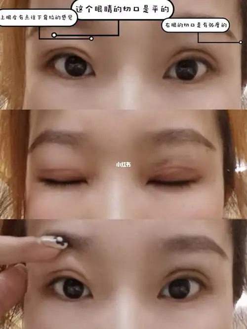 全切双眼皮 术后15天_全切双眼皮_双眼皮手术_美妆_医美整形