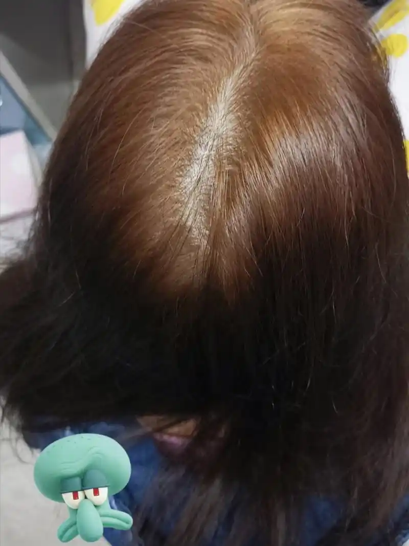 求助染发爆顶怎么办 姐妹们如图,我爆顶成这样了该怎么补救 看了好多